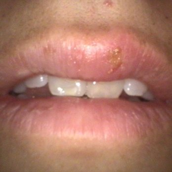 John VanCamp, DDS - Day 2. Already passed the inflamed itchy painful stage, skipped over the weeping stage, into the drying stage. Day 3 it was already a scab. - Oral Surgeons Near Me - San Francisco, California John VanCamp, DDS - Day 2. Already passed the inflamed itchy painful stage, skipped over the weeping stage, into the drying stage. Day 3 it was already a scab. - Oral Surgeons Near Me - San Francisco, California