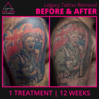 Legacy Tattoo Removal - A before and after one treatment, 12 weeks later. - Tattoo Removal Near Me - Edmonton, Alberta Legacy Tattoo Removal - A before and after one treatment, 12 weeks later. - Tattoo Removal Near Me - Edmonton, Alberta