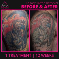 Legacy Tattoo Removal - A before and after one treatment, 12 weeks later.