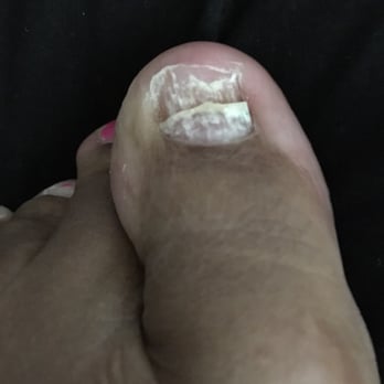 Lux Nails - This is what happened to my toe when I went to get a pedicure for Mother's Day at Lux Nail Salon in Raleigh,NC on Creedmoor Road. - Nail Salons Near Me - Raleigh, North Carolina