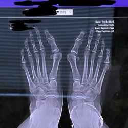 Healthy Feet Podiatry- Tampa FL - X ray of my feet before
