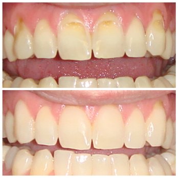 Warner Dental - Non-invasive cosmetic bonding. Treatment of enamel erosion. - General Dentistry Near Me - Fountain Valley, California Warner Dental - Non-invasive cosmetic bonding. Treatment of enamel erosion. - General Dentistry Near Me - Fountain Valley, California