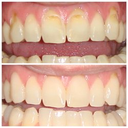 Warner Dental - Non-invasive cosmetic bonding. Treatment of enamel erosion.