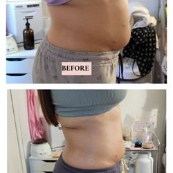 Allure Body Sculpting - Right angle on 8th cavitation and wood therapy session
