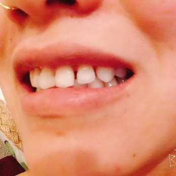 Nguyen Frank Hung T, DMD MSD - Many gaps. I have been crying for 3months. - General Dentistry Near Me - Milpitas, California Nguyen Frank Hung T, DMD MSD - Many gaps. I have been crying for 3months. - General Dentistry Near Me - Milpitas, California