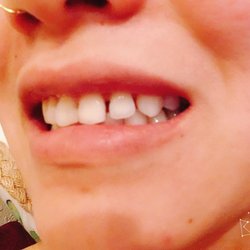 Nguyen Frank Hung T, DMD MSD - Many gaps. I have been crying for 3months.