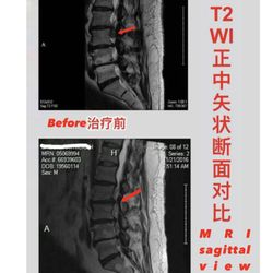 Pain Management & Acupuncture Healing - The same  patient's  MRI images were comparing after the 8 treatments
