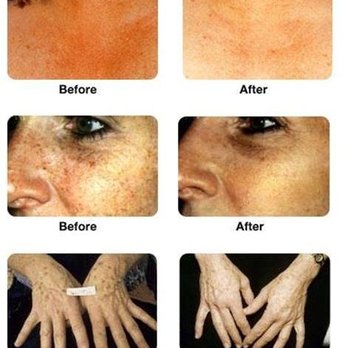 Tender Laser Care - Let people notice you, not your pigmentation & spots. Be a better version of you, with better skin!
IPL / Intense Pulse Light / Photofacial - Laser Hair Removal Near Me - Austin, Texas Tender Laser Care - Let people notice you, not your pigmentation & spots. Be a better version of you, with better skin!
IPL / Intense Pulse Light / Photofacial - Laser Hair Removal Near Me - Austin, Texas