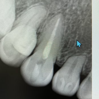 17th Street Modern Dentistry - Root canal that wasn't done properly - General Dentistry Near Me - Costa Mesa, California 17th Street Modern Dentistry - Root canal that wasn't done properly - General Dentistry Near Me - Costa Mesa, California