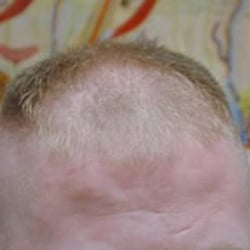 Hair Loss Control Clinic - Before - image2