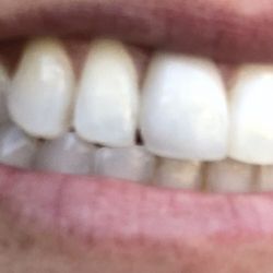 A Belmont Dental Care - He made rounded on one side in order to fit then tried to tell me that women are suppose to have rounded because its more feminine