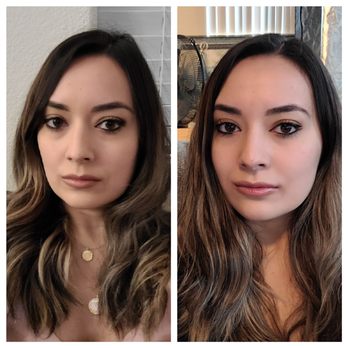 AnwarMD.com - Fillers (before left, after right) - Medical Spas Near Me - Roseville, California