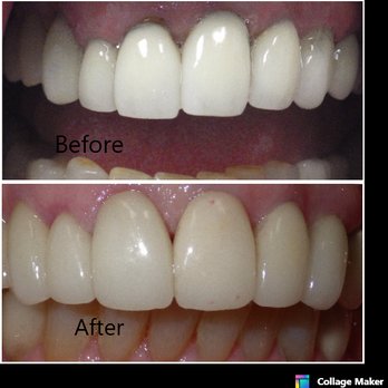 Hatch Dentistry - 6 upper porcelain crowns - General Dentistry Near Me - Gilbert, Arizona Hatch Dentistry - 6 upper porcelain crowns - General Dentistry Near Me - Gilbert, Arizona
