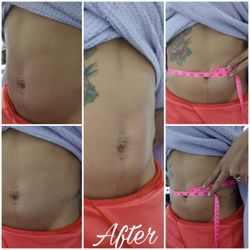 Jewels Aesthetics - Body Sculpting Treatment Slim Waist Treatment After Results