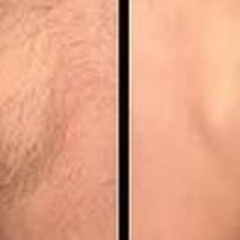Calgary Men Waxing - Waxing Near Me - Calgary, Alberta Calgary Men Waxing - Waxing Near Me - Calgary, Alberta