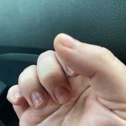 Nails drilled down, growing out from healthy nail Nails drilled down, growing out from healthy nail