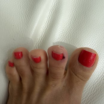 Club Nails - Look what she did to my toe!!! - Nail Salons Near Me - Laguna Niguel, California Club Nails - Look what she did to my toe!!! - Nail Salons Near Me - Laguna Niguel, California