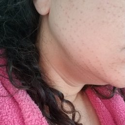 Burn marks on my face from laser. rev