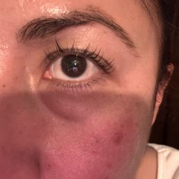 The missing lashes is in the middle The missing lashes is in the middle