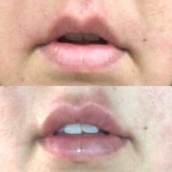 Uplift Medspa - Before and after!