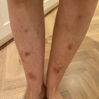All Seasons Body Work - Woke up with these bruises today after having a massage yesterday - Reflexology Near Me - New York, New York All Seasons Body Work - Woke up with these bruises today after having a massage yesterday - Reflexology Near Me - New York, New York