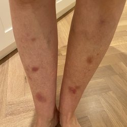 Woke up with these bruises today after having a massage yesterday