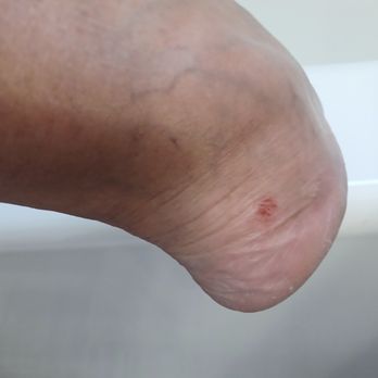 Savy Nails - Ouch can't wear shoes until they heal. - Nail Salons Near Me - Las Vegas, Nevada