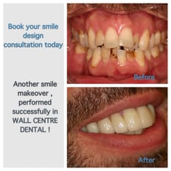 Wall Centre Dental - Another Successful full mouth smile design and reconstruction !