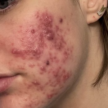 Face Reality Acne Clinic - Acne Treatment Face - Skin Care Near Me - San Ramon, California