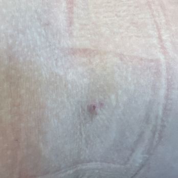 CSL Plasma - Bruised vein - Blood & Plasma Donation Centers Near Me - Yuma, Arizona CSL Plasma - Bruised vein - Blood & Plasma Donation Centers Near Me - Yuma, Arizona