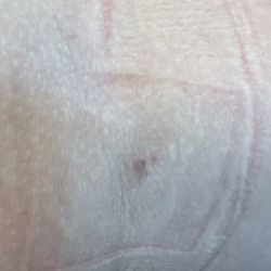 CSL Plasma - Bruised vein