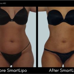 First State Med Spa - SmartLipo is Laser Liposuction, where we can tighten skin and remove fat! Little down-time and amazing results!
