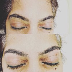 Queens Laser Hair Removal