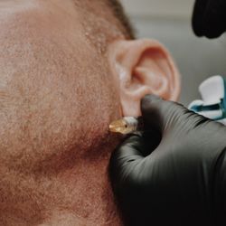 Uptown Medical Aesthetics - Jawline Filler