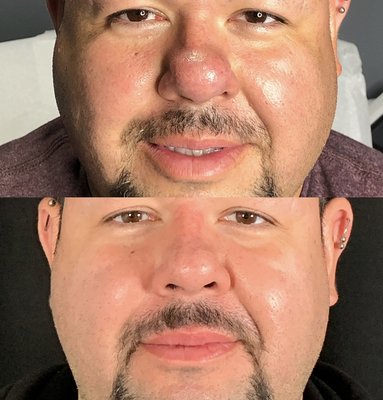 Nostril/Bulbous Tip Slimming - Nonsurgical nostril slimming using kenalog injections or our PDO Thread Cat Whisker treatment Nostril/Bulbous Tip Slimming - Nonsurgical nostril slimming using kenalog injections or our PDO Thread Cat Whisker treatment