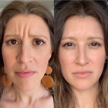 Enhance Aesthetics - Before & After - Aestheticians Near Me - Ontario, California Enhance Aesthetics - Before & After - Aestheticians Near Me - Ontario, California