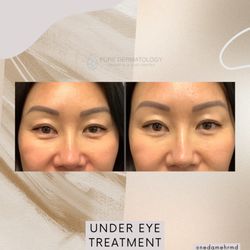 Pure Dermatology Cosmetic & Hair Center - Under Eye Treatment