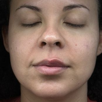 GC Skin Med Spa - Before & after - Medical Spas Near Me - Sherman Oaks, California GC Skin Med Spa - Before & after - Medical Spas Near Me - Sherman Oaks, California