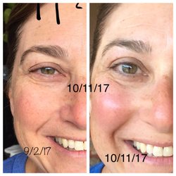 Image Insight Aesthetics & Artistry - Chemical peel, facial series