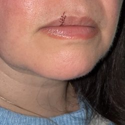 Tysons Corner Dental Arts Center - The "doctor" cut her so badly she required this many stitches.