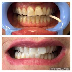 Ohana Teeth Whitening By DaVinci - Instant Results!! Ask about my 60 minute whitening specials!