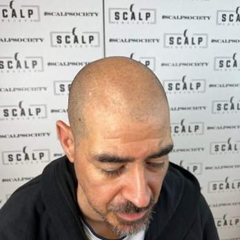Scalp Society - Hair Loss Centers Near Me - San Jose, California