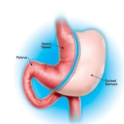 Laparoscopic Gastrectomy Sleeve