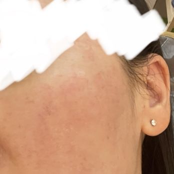 Goeun Beauty - After facial 10/4/24 - Skin Care Near Me - Burlingame, California