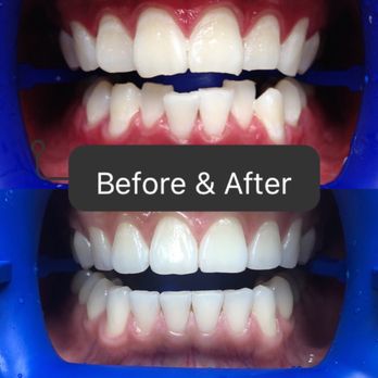 UDream Dental - San Gabriel - Before and after ortho! They have new braces technology that only took about a year and a half from start to finish - Orthodontists Near Me - San Gabriel, California UDream Dental - San Gabriel - Before and after ortho! They have new braces technology that only took about a year and a half from start to finish - Orthodontists Near Me - San Gabriel, California