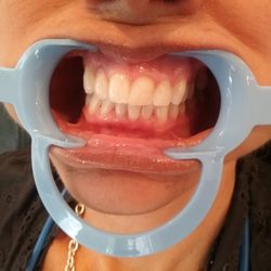 DaVinci Teeth Whitening