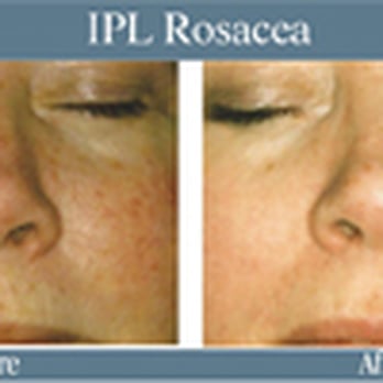 About Face - Rosacea before & after treatment at About Face - Hair Removal Near Me - Glasgow, GLG About Face - Rosacea before & after treatment at About Face - Hair Removal Near Me - Glasgow, GLG