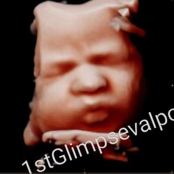 1st Glimpse 3d 4d Ultrasound