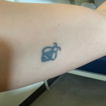 Sideshow Tattoos & Piercings - After 5 tattoo removal laser sessions - Piercing Near Me - Enterprise, Alabama Sideshow Tattoos & Piercings - After 5 tattoo removal laser sessions - Piercing Near Me - Enterprise, Alabama