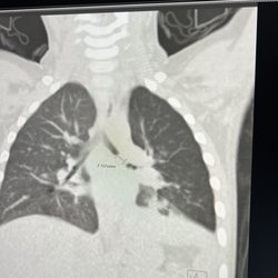 Hendrick Medical Center South - Peabit blocking the left lung
